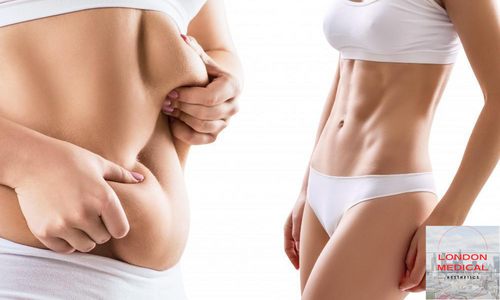 ultrasound cavitation