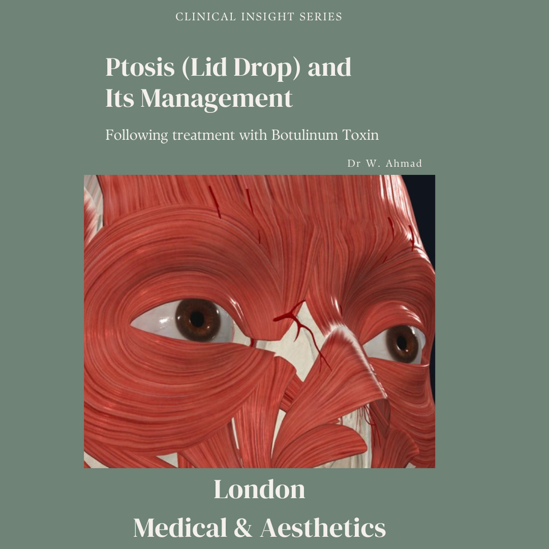 Eyelid Ptosis from Botox