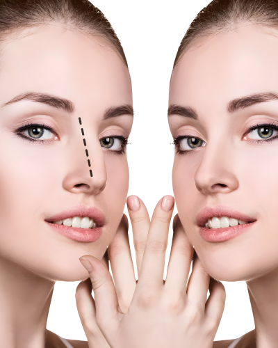 Liquid Rhinoplasty